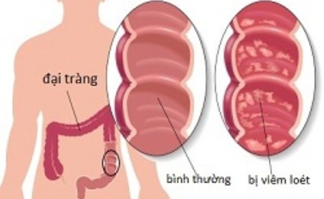 Polyp Tuyến đại tràng
