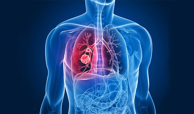 Bệnh phổi tắc nghẽn mạn tính (COPD)