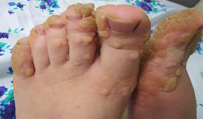 Vấn đề về Mụn cóc