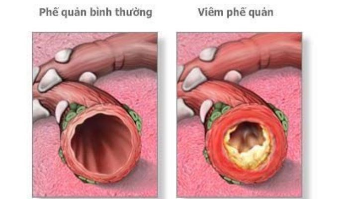 Hen phế quản hay còn gọi là suyễn