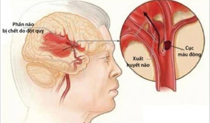 Ngăn ngừa đột quỵ