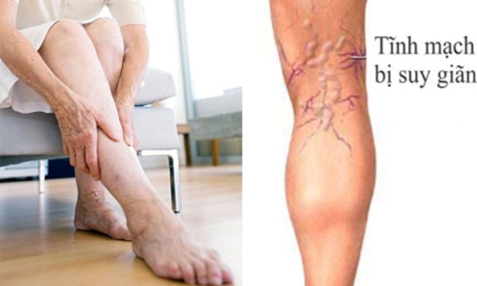 Huyết khối tĩnh mạch sâu