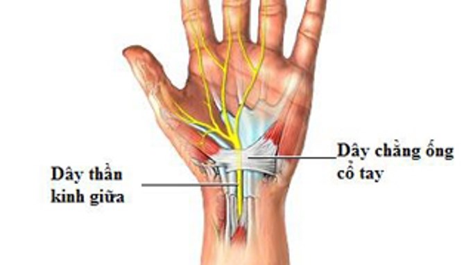 Hội chứng ống cổ tay